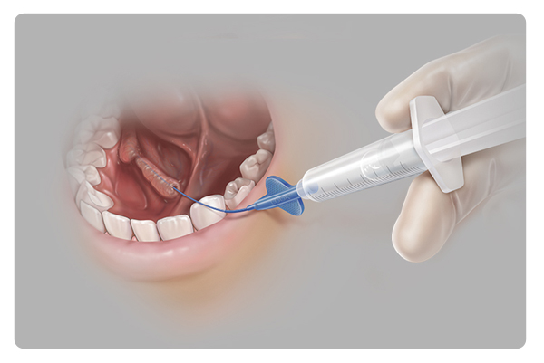 Sialendoscopy