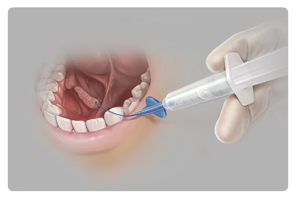 Sialendoscopy